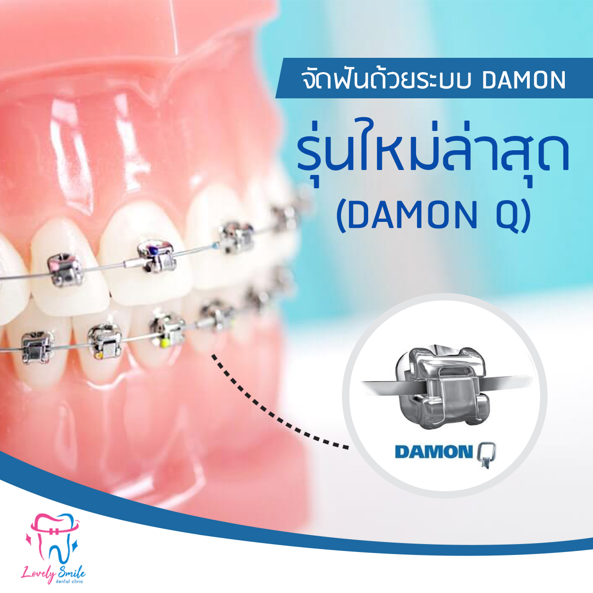 จัดฟันด้วยระบบ Damon รุ่นใหม่ล่าสุด (Damon Q)