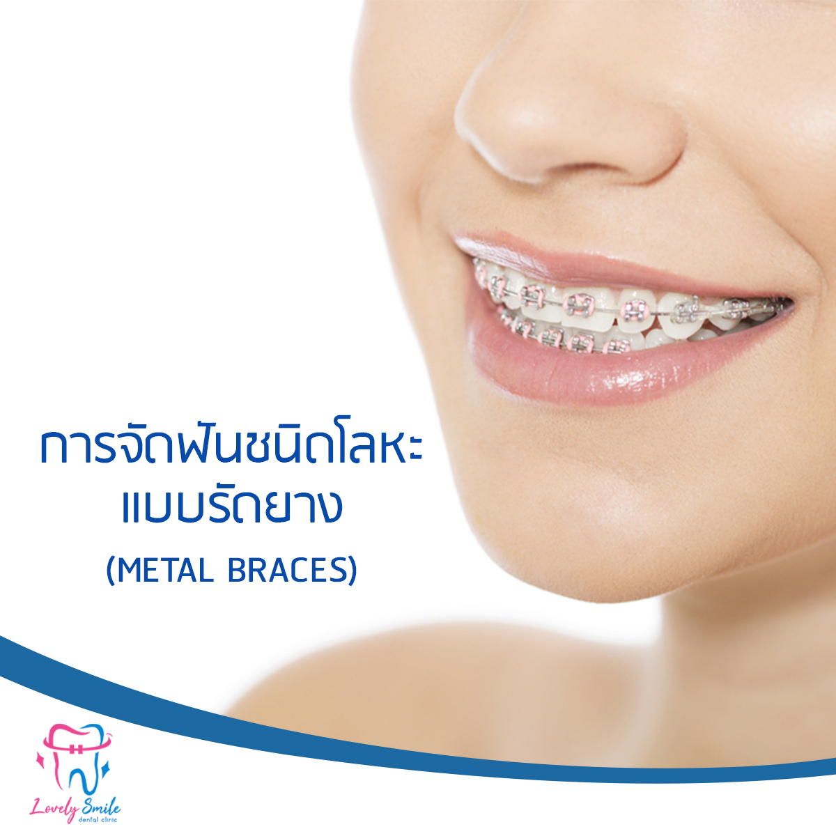 การจัดฟันชนิดโลหะ แบบรัดยาง (Metal braces)