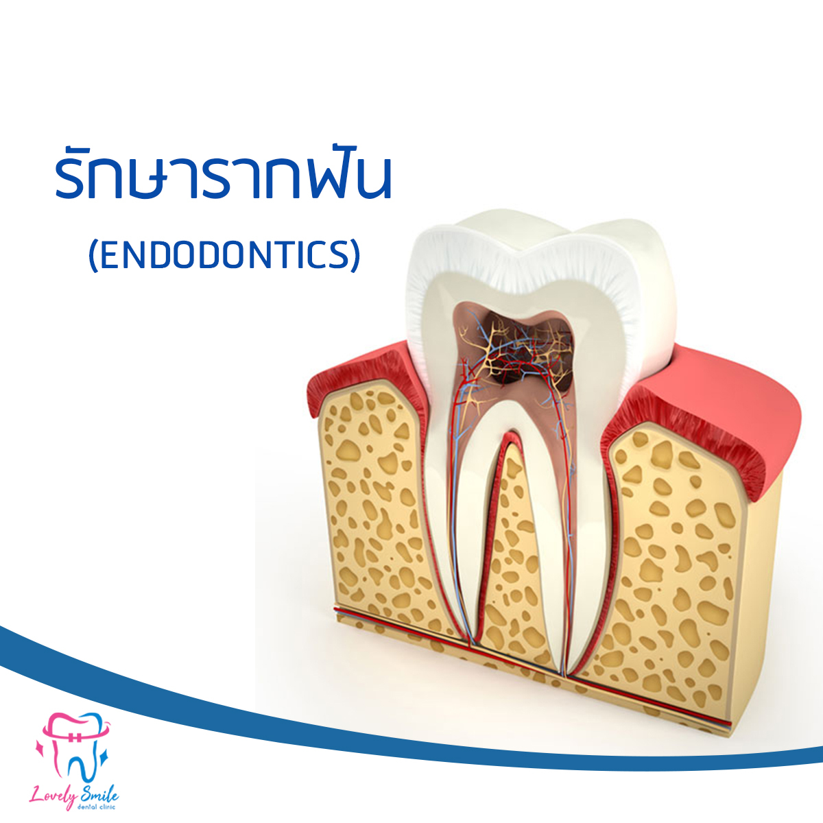 รักษารากฟัน (Endodontics)